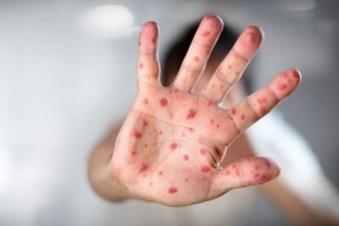 Понад 50 дітей в Івано-Франківській області захворіли на кір через неправильне зберігання вакцини