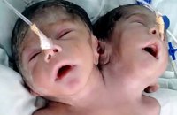 В Индии родился двухголовый ребенок