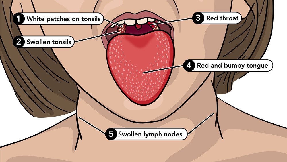 Симптом малинового язика