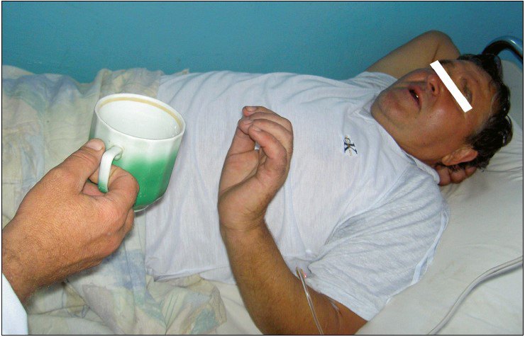 Гідрофобія у хворого на сказ