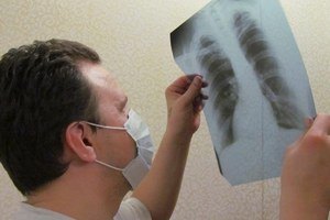 Кабмин запланировал излечить 70% больных туберкулезом