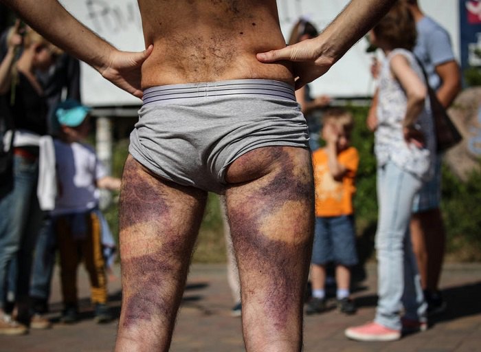 Фото людини, що зазнала тортур у білоруському ізоляторі