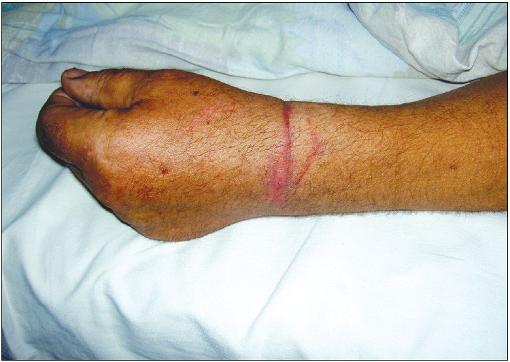 Рубець після рани, завданої скаженим собакою у пацієнта з летальним наслідком