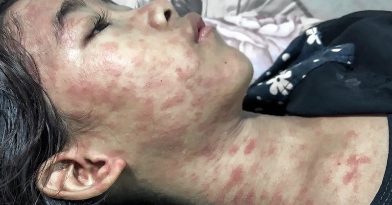 Пацієнт, вражений вірусом Чикунгунья