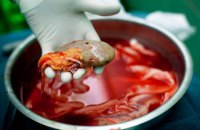 Зеленский подписал закон о трансплантации