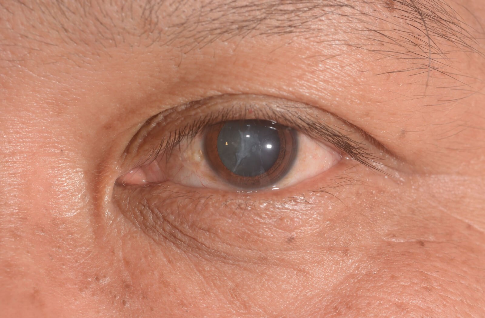 Помутніння кришталика ока