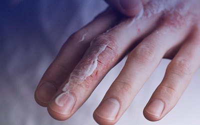 Алергія на холод? Так, вона існує. Пояснюємо симптоми, причини та лікування 