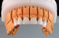 Коронки на зубы в стоматологии ЛюмиДент. Какие лучше ставить коронки на жевательные зубы