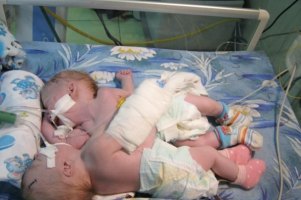 Померли сіамські близнюки із Краматорська
