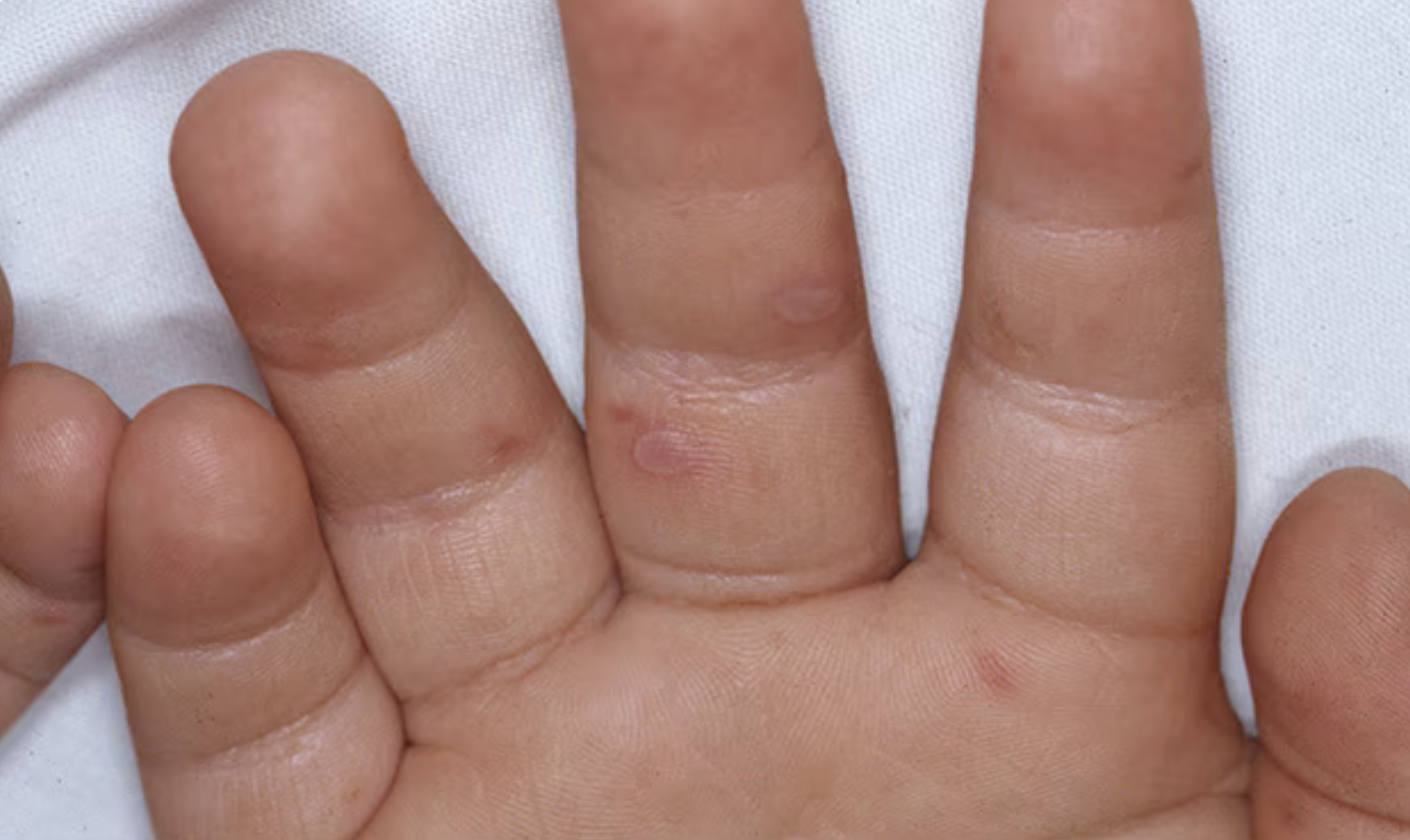 Хвороба Коксакі