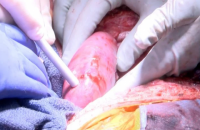 Уперше в історії людині пересадили дві свинячі нирки 