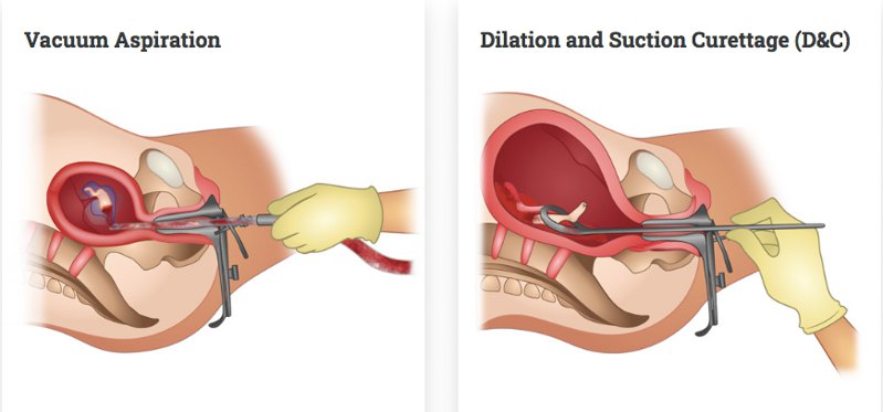 Хірургічні методи: вакуумний аборт і кюретаж (праворуч)