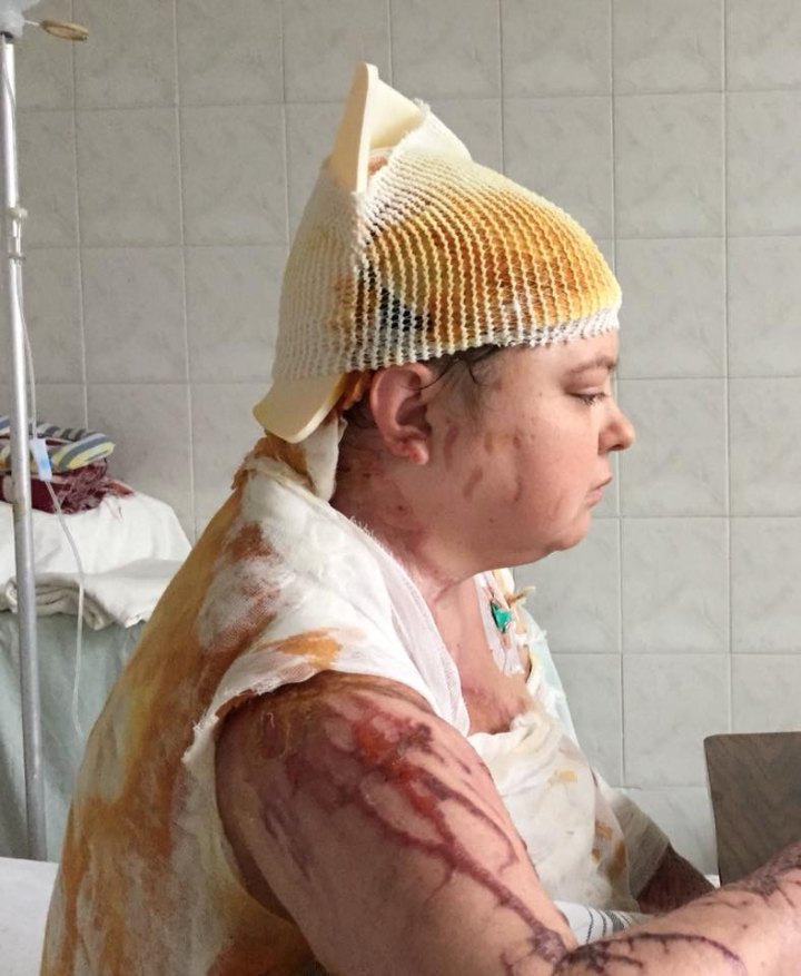 Катерина Гандзюк у лікарні з опіками шкіри