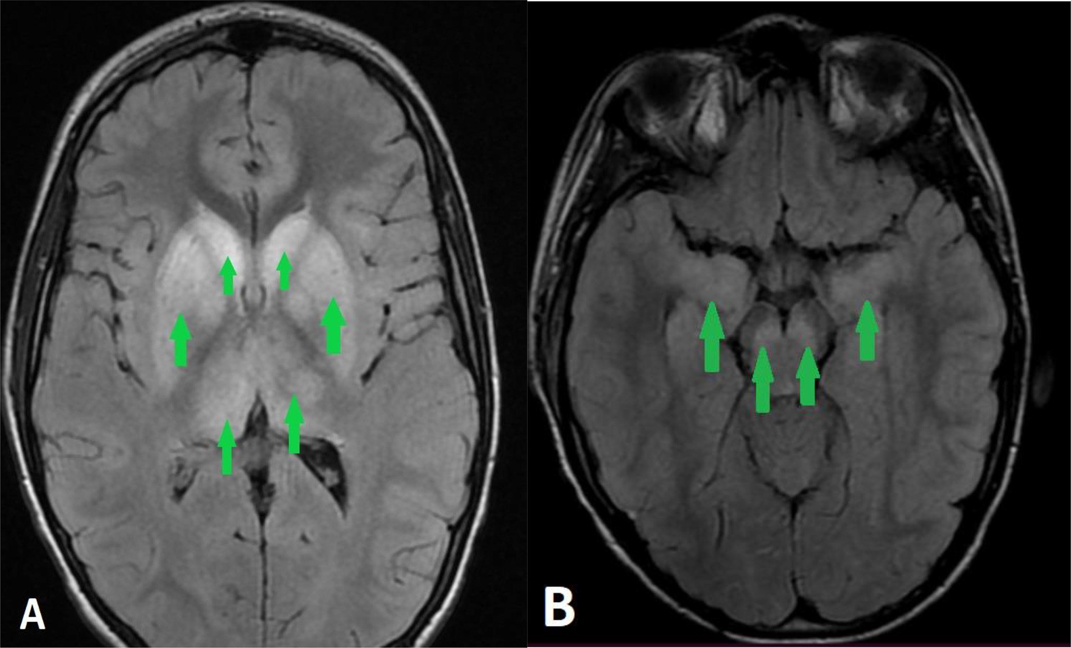 запалення мозку та його оболонок у пацієнта, хворого на сказ