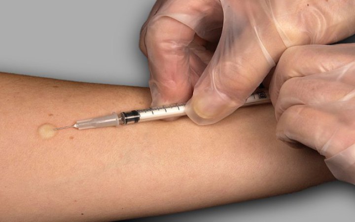 Манту – в минулому: в Україні впроваджують нові методи діагностики туберкульозу