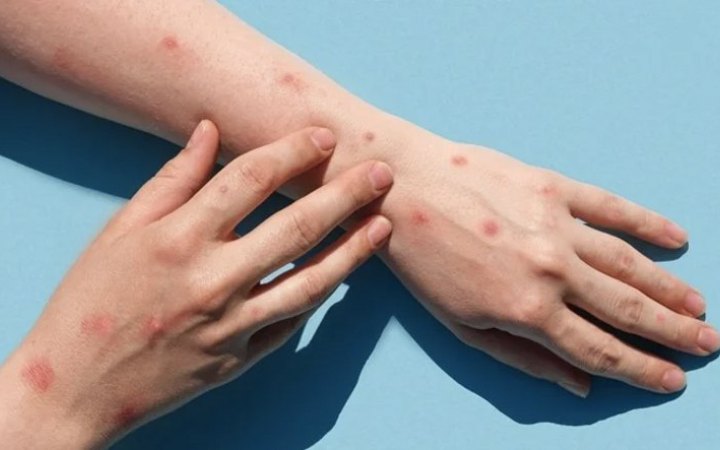 Перший випадок інфекції mpox за межами Африки зафіксували у Швеції