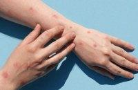 Перший випадок інфекції mpox за межами Африки зафіксували у Швеції