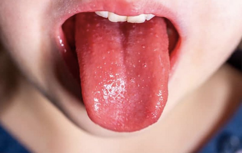 Язик дитини під час скарлатини