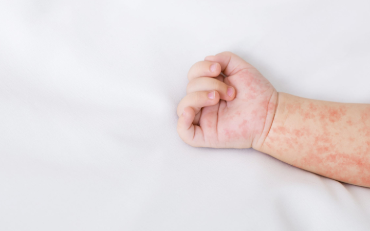 В Україні зростає кількість випадків кору: за 4 місяці 2025 року захворіли 684 людини