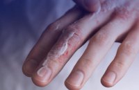 Алергія на холод? Так, вона існує. Пояснюємо симптоми, причини та лікування