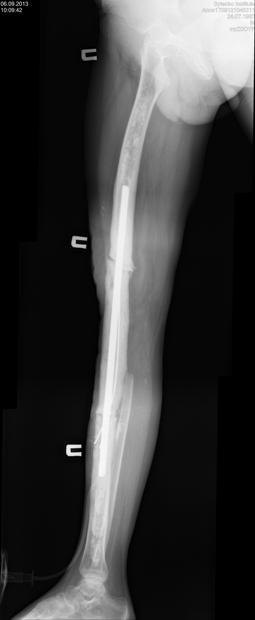 Нога в данный момент - рентгеновский снимок 