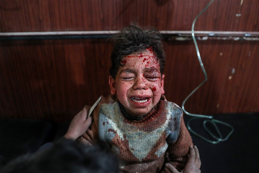 Поранений хлопчик після обстрілу м. Дума, Східна Гута, Сирія, 8 лютого 2018 року.
