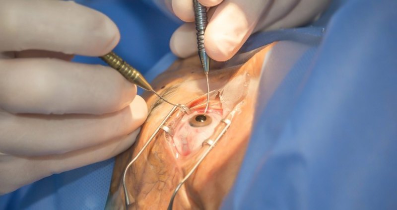 Операції з видалення катаракти й імплантації кришталика