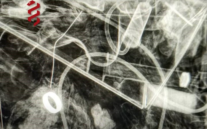 Як медики знайшли обручку пораненого військового за допомогою рентгену