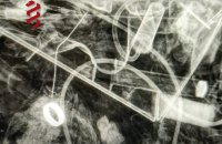 Як медики знайшли обручку пораненого військового за допомогою рентгену