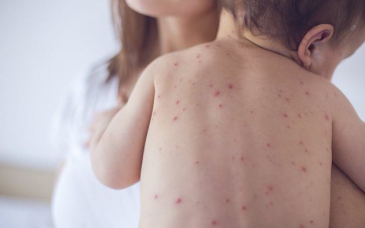 В Україні росте захворюваність на кір, пік очікують на осінь, — ЦГЗ
