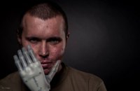 Бионические протезы рук будут устанавливать в Украине со следующего года