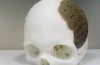 Американцу заменили кости черепа при помощи 3D-принтера