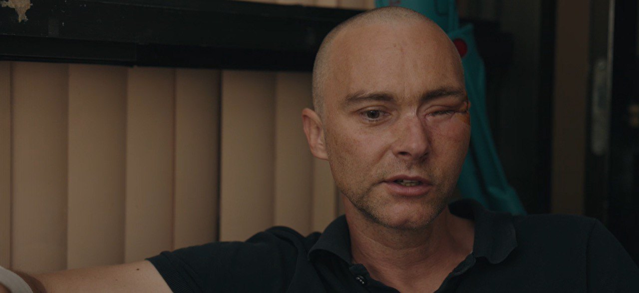 Сергій після операції 