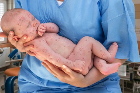 У Львові п'ятеро немовлят захворіли на кір одразу після народження
