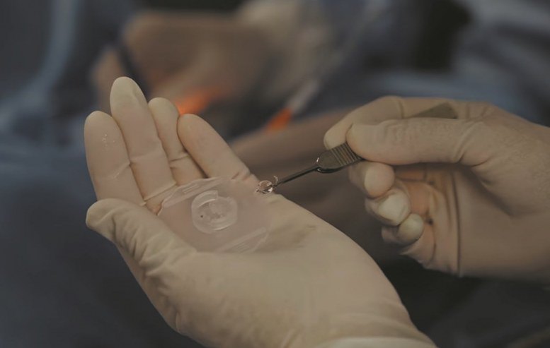 Операція зі встановлення штучного кришталика в Золочівській ЦРЛ, жовтень 2025 р.