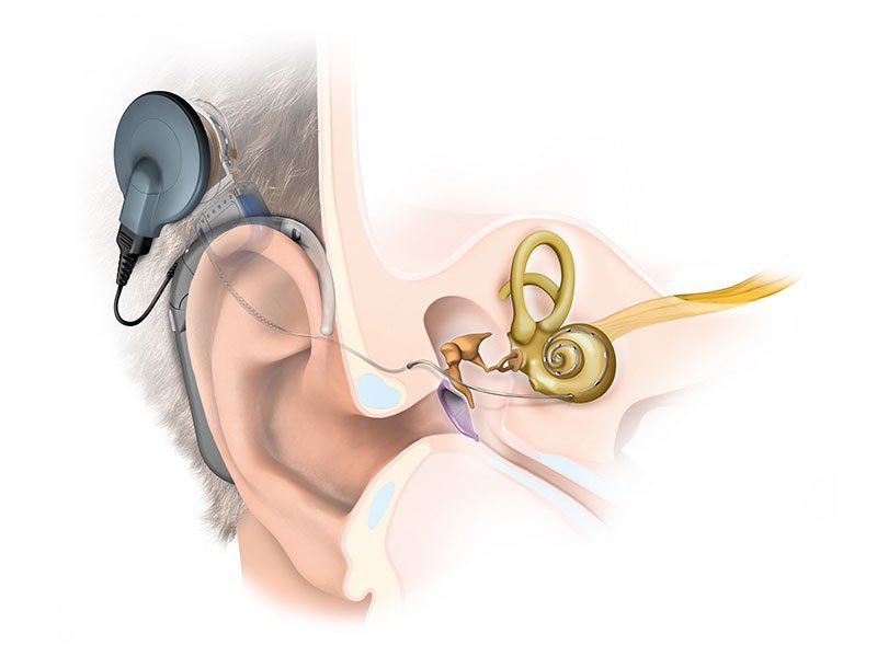 Кохлеарна імплантація 