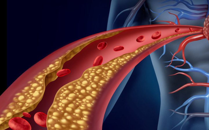 Як на серце та судини може вплинути зайва вага, до чого тут інсульт та генетична "лотерея"