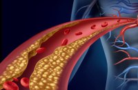 Як на серце та судини може вплинути зайва вага, до чого тут інсульт та генетична "лотерея"