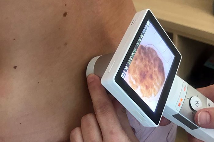 Діагностика
меланоми