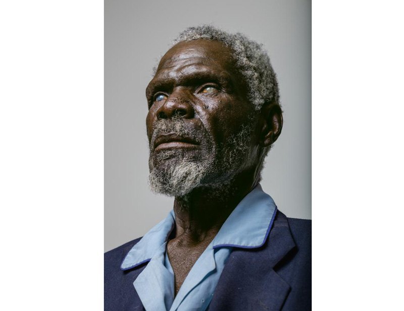 67-летний Герд Гаманаб слишком поздно обратился за медицинской помощью: долгие годы труда на намибском солнце и пыль разрушили
роговицы обоих глаз.