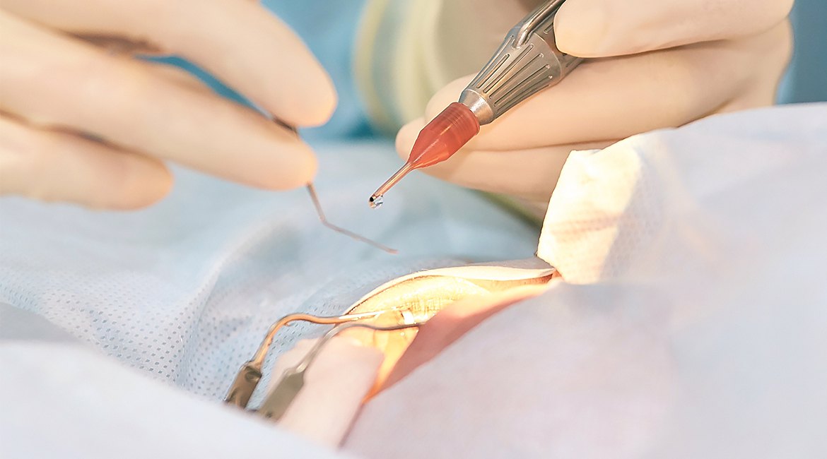 Лікування катаракти