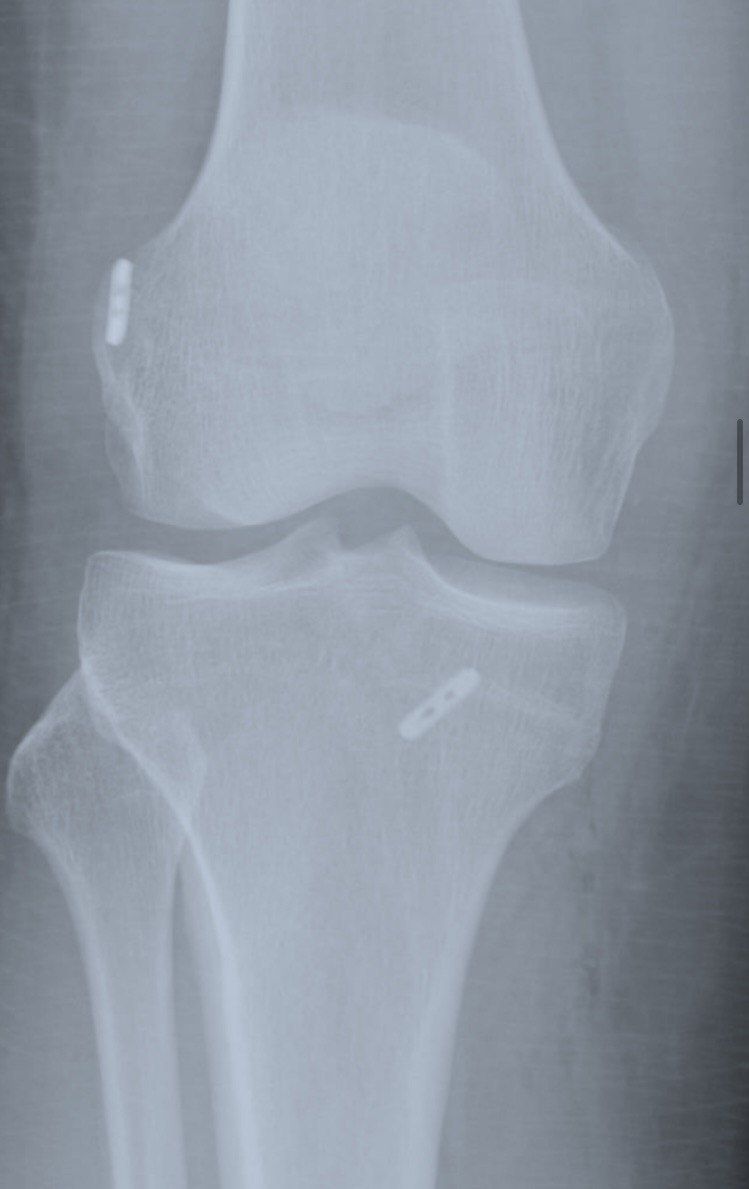 Зрештою, після операції в коліні з'явилися ось такі красиві титанові ґудзики