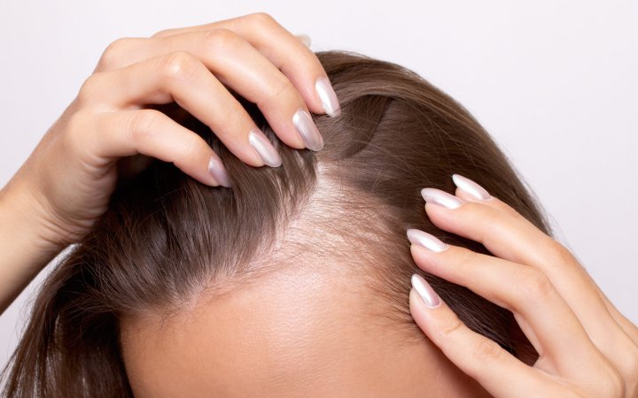 «Волосся сиплеться, нігті ламкі — здам аналіз на феритин»: пояснюємо про дефіцит заліза та його симптоми 