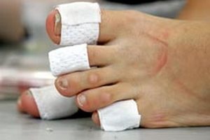 Липосакция пальцев ног бьет рекорды по популярности