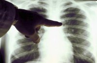 Лікарні на звільненій від росіян Херсонщині отримали рентгенапарати