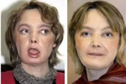 У Франції померла перша в світі жінка, якій пересадили обличчя