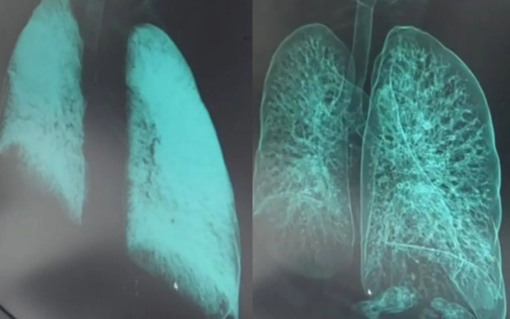 The Sun: російські окупанти отримали «небачене раніше» отруєння легень після «подорожі» газовою трубою на Курщині