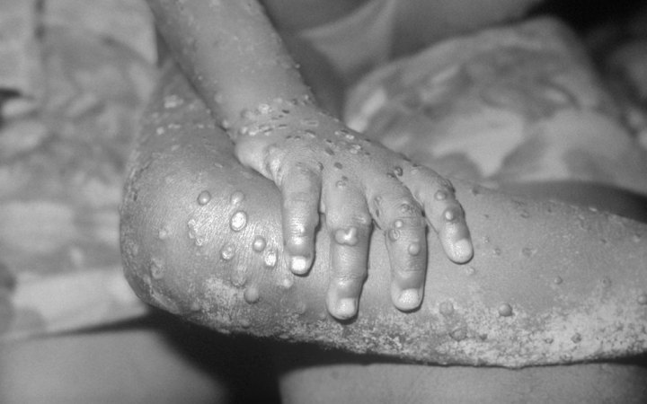 First case of monkeypox officially confirmed in Ukraine