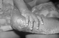 First case of monkeypox officially confirmed in Ukraine