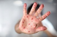 Measles outbreak claims third life this year